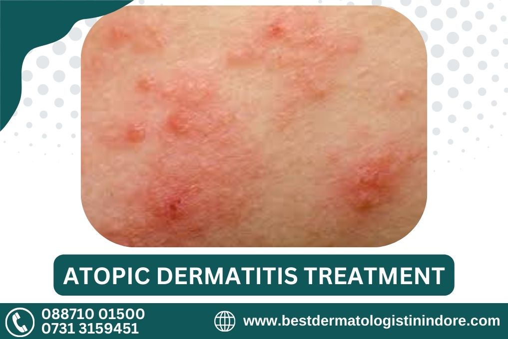 Best Doctor for Atopic Dermatitis in Indore